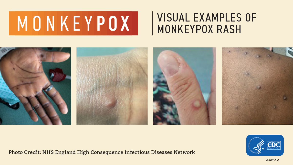 Frederick County Health Officials Are Selective On Who Can Get Monkeypox Vaccine