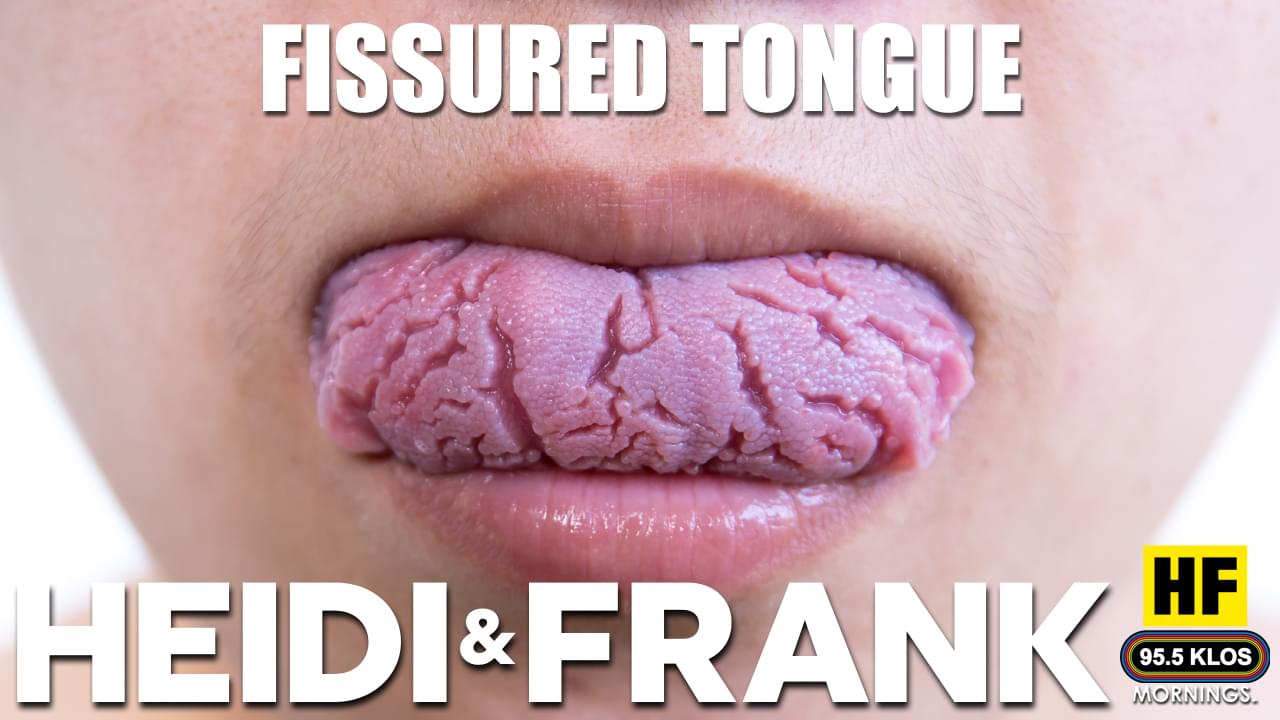 Fissured Tongues