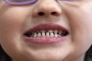 FDA and RFK Jr. aim to remove ingestible fluoride products used to protect kids’ teeth