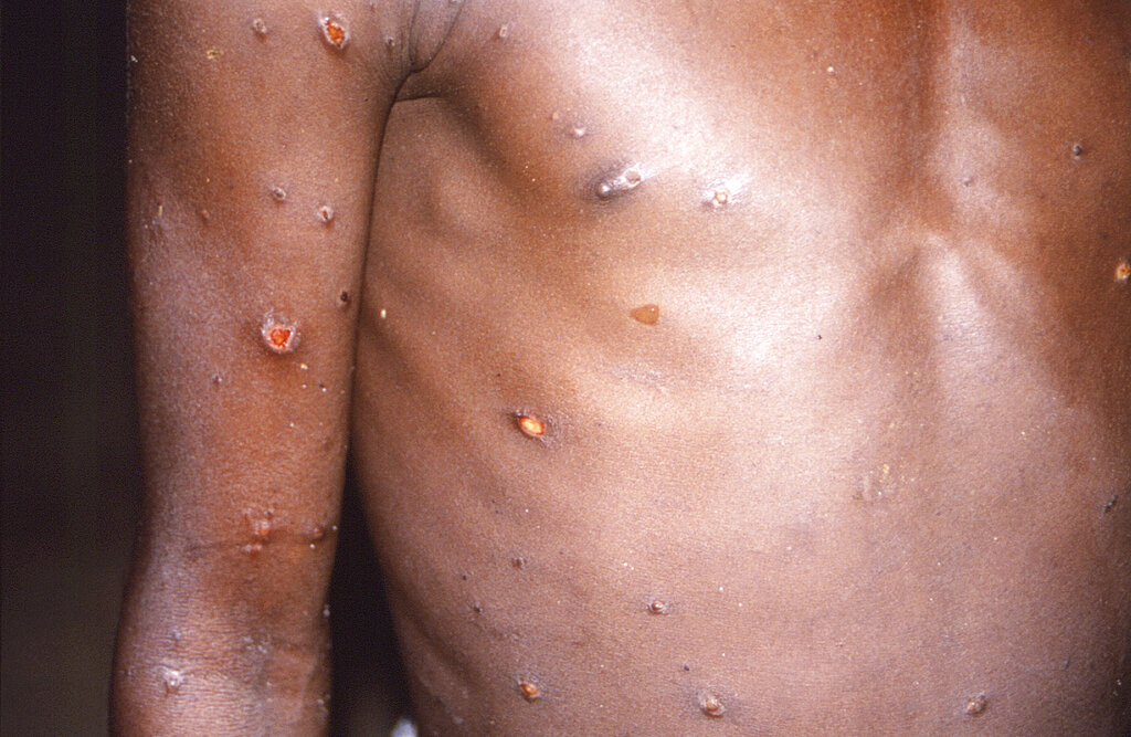 Monkeypox spreading in New York