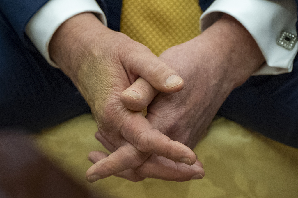 Trump is checked for lower leg swelling and diagnosed with a common condition in older adults