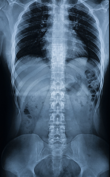 Melissa in the Morning: Spinal Stenosis