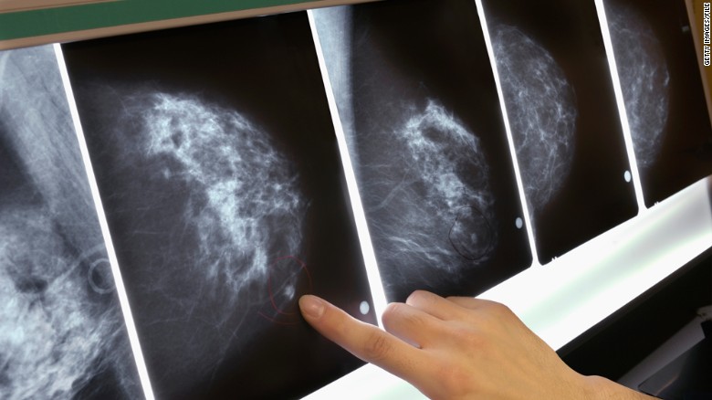 New guidelines on breast cancer screening