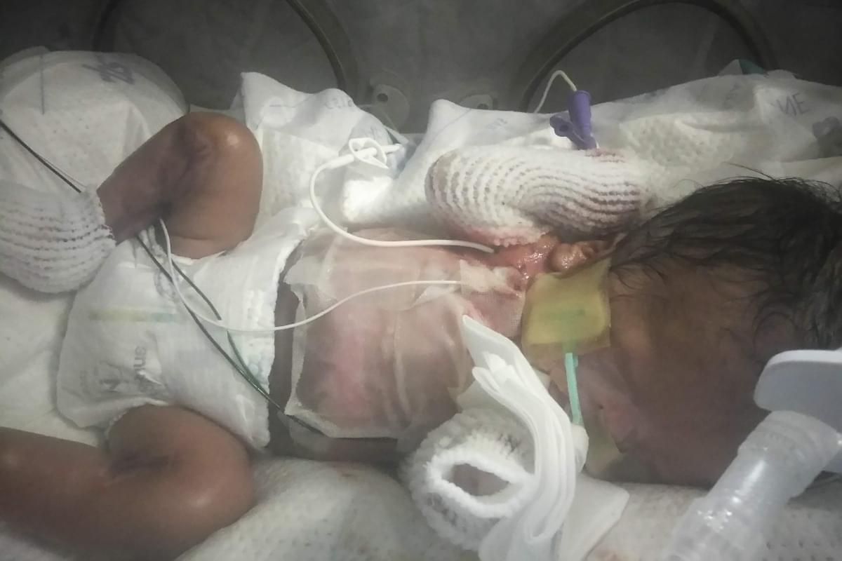 San Antonio Community Raising Money for Baby Boy Born Without Skin