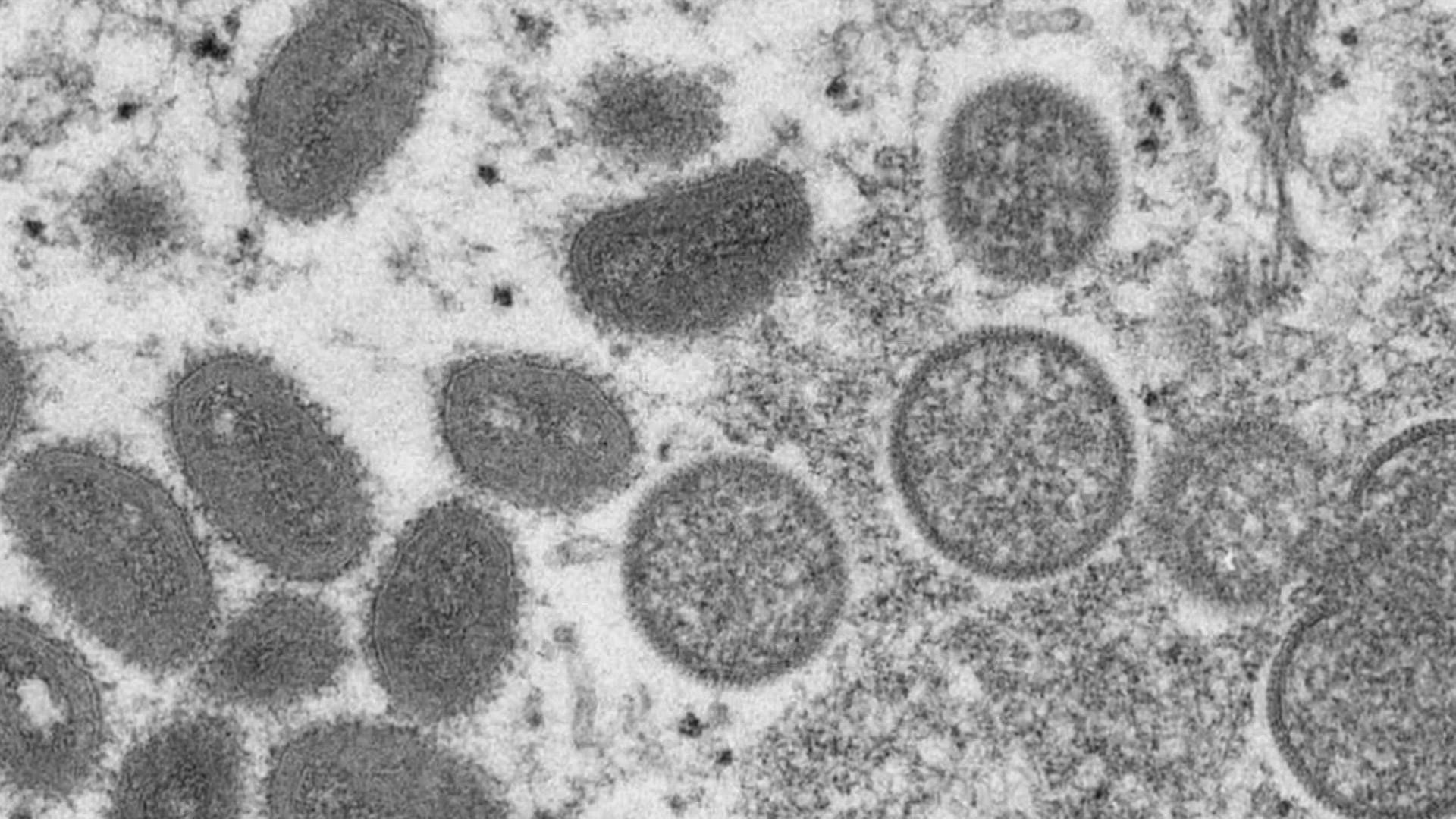 Texas Confirms First Death of Person Diagnosed with Monkeypox