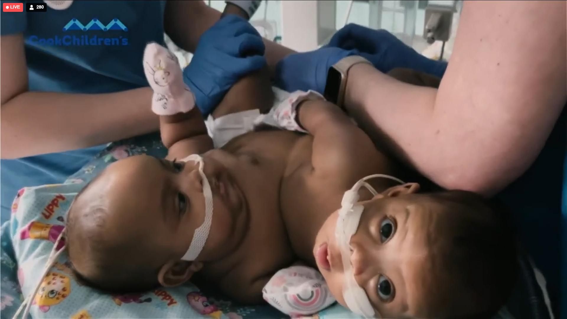 Cook Children’s Separates Conjoined Twins in Historic Surgery
