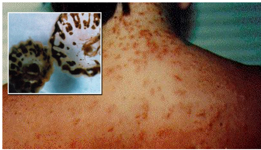 Warning Issued of Sea Lice Invading Florida Beaches