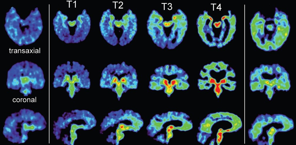 Morning News: Study on Brain Injuries in the NFL