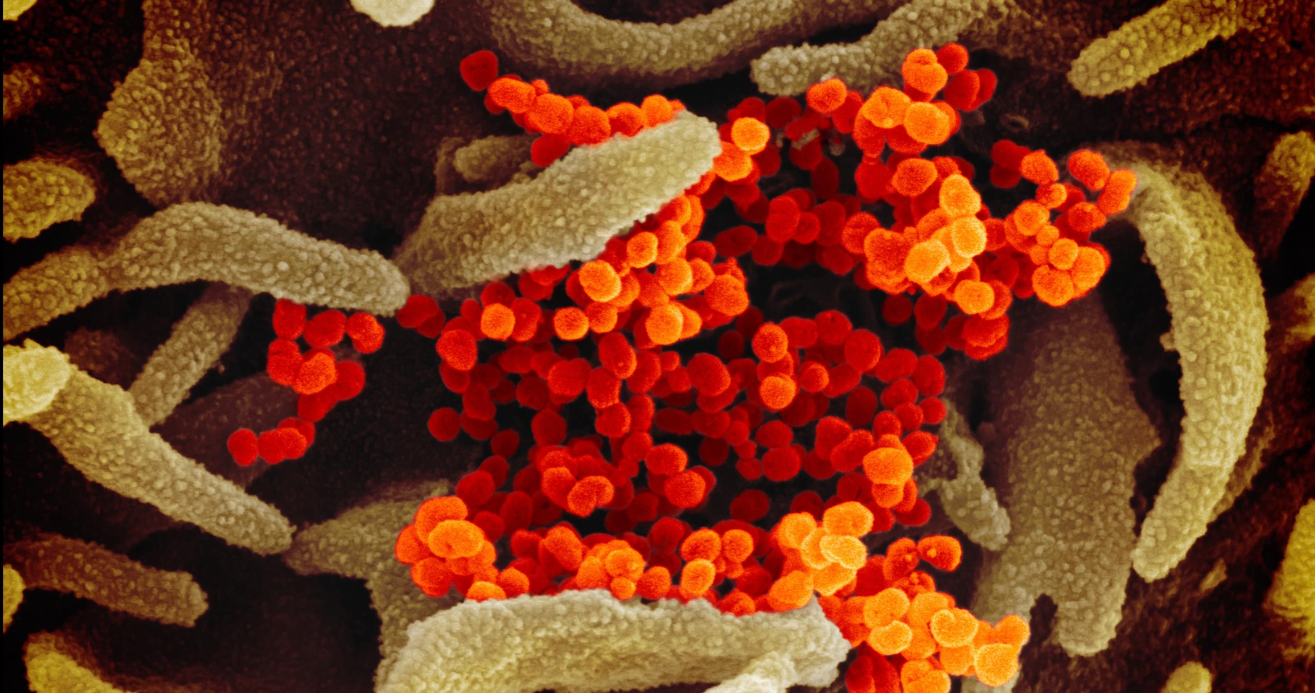 Nine Additional COVID-19 Cases in Dallas County, Ages ranging from 20-70, Three are critical