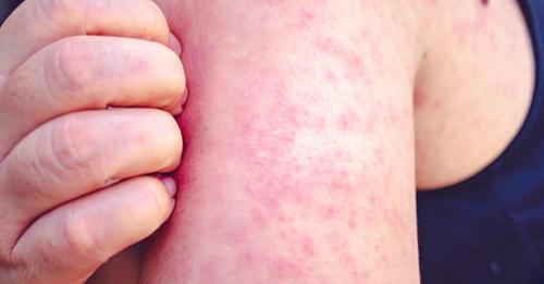 Tazewell Health Dept. gives tips on measles as cases rise