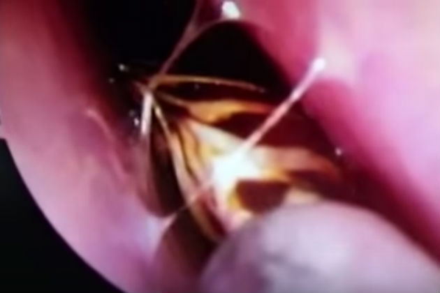 Watch Doctors Pull a Live Cockroach Out of a Woman’s Skull [VIDEO]