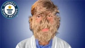 Man Sets Record For World’s Hairiest Face.