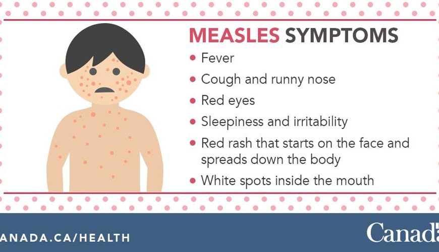 Measles Infographic. Health Canada