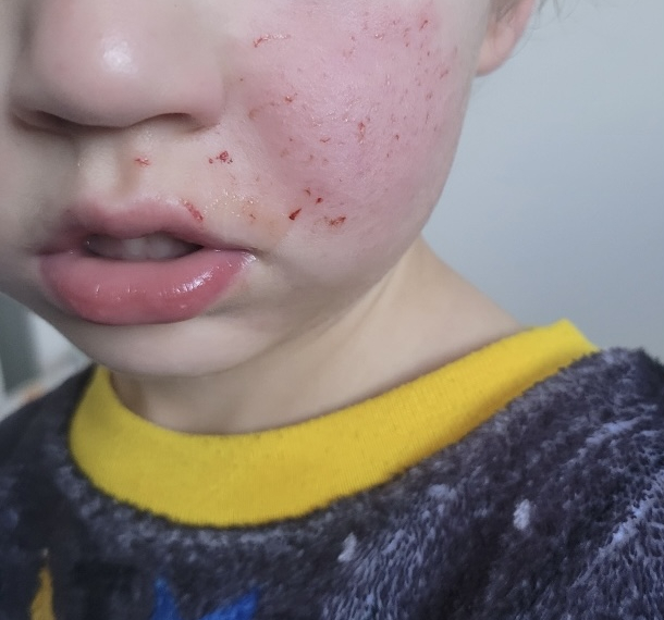 Sledding Mishap – The Tale of a 3 Year Old